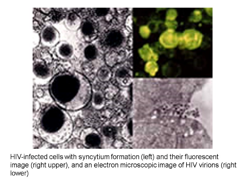 HIV-infected cells with syncytium formation (left) and their fluorescent image (right upper), and an